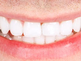 Bright white smiling teeth