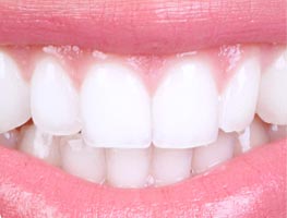 Bright white smiling teeth